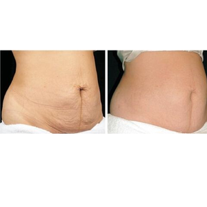 Powerful scar removal and Stretch Mark cream